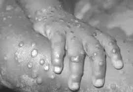 Bayelsa monkeypox patient commits suicide, FG clears Lagos, others