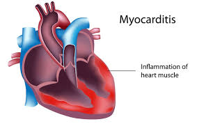 Myocarditis on the Rise